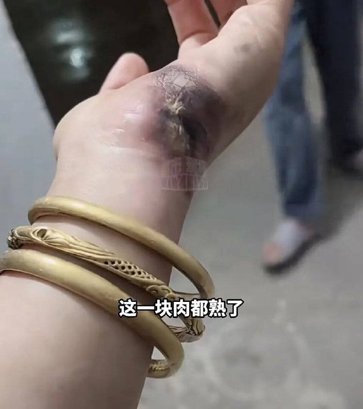 世界杯信用网平台出租
_手被烧熟！金手镯被烧熔！女子给电动车充电世界杯信用网平台出租
，不慎碰到充电口受伤