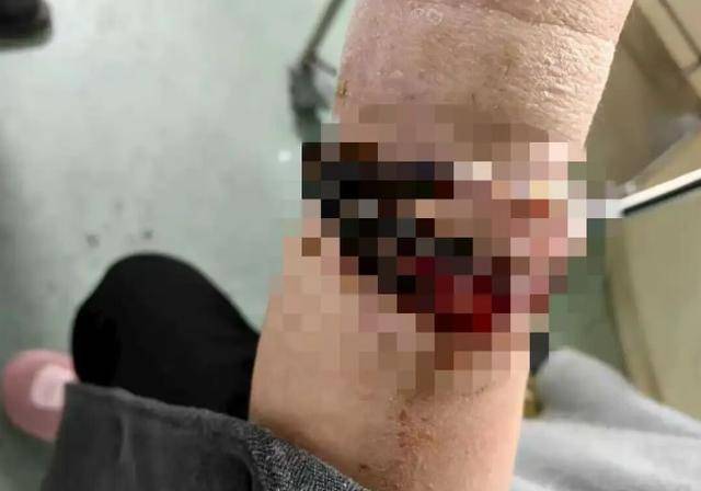 登1信用盘代理_女子手镯10年没摘竟“长”进肉里登1信用盘代理！医生：再晚点就保不住了