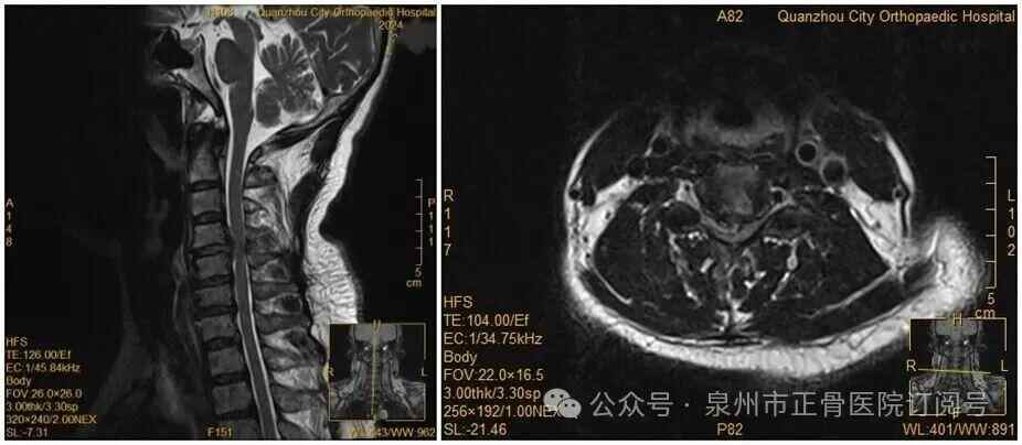罗瑟汉姆 vs 保顿艾尔宾
_女子因手麻到医院就诊罗瑟汉姆 vs 保顿艾尔宾
,拒绝医生颈椎手术建议,当晚翻身竟导致瘫痪,医生提醒→
