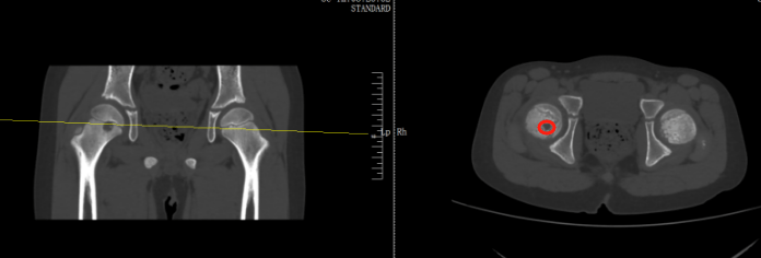 那可恩普拉托姆联vs查英特贺纳比尔
_13岁女孩频繁屁股疼确诊骨癌那可恩普拉托姆联vs查英特贺纳比尔
!或将截掉一侧屁股